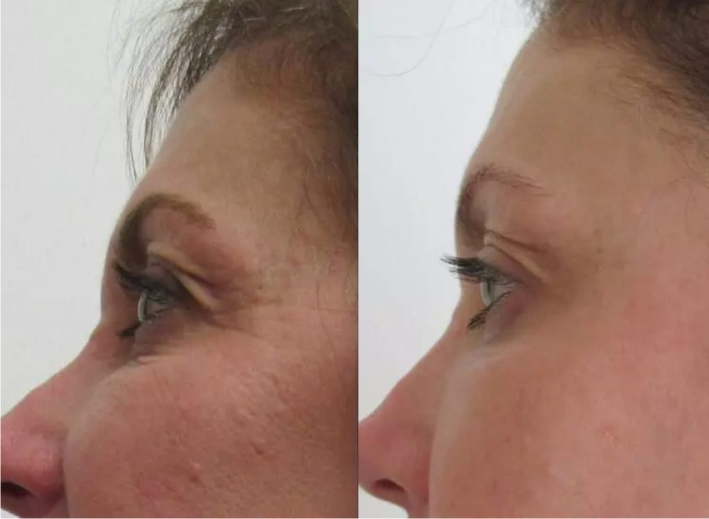 before and after images of a woman who had Fractional CO₂ treatment